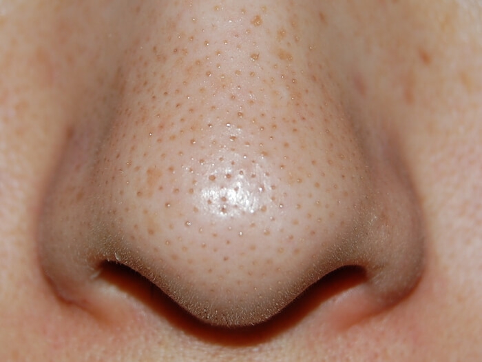 洗顔ブラシはいちご鼻やニキビの改善に効果あるの？