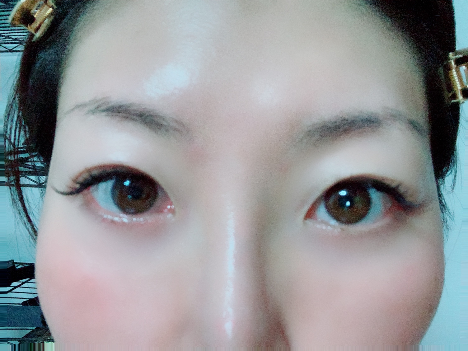東京中央美容外科を使ったふっきーさんのクチコミ画像3